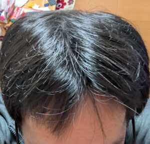 AGA治療　12か月目全体