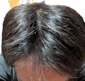 AGA治療　15か月目②