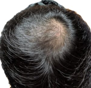 AGA治療　15か月目①