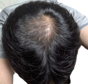 AGA治療　18か月後②