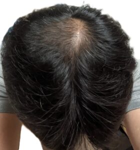 AGA治療　18か月後①