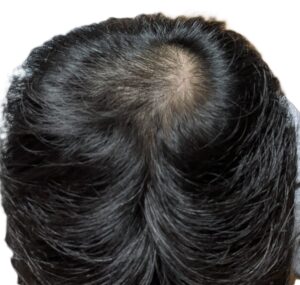 AGA治療　21か月後