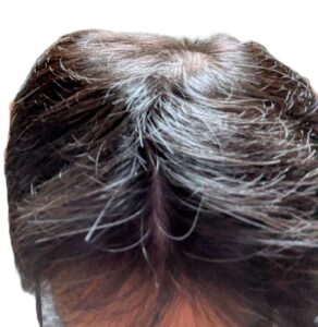 AGA治療　2年経過①