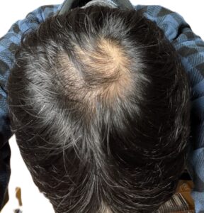 AGA治療　2年経過⓷